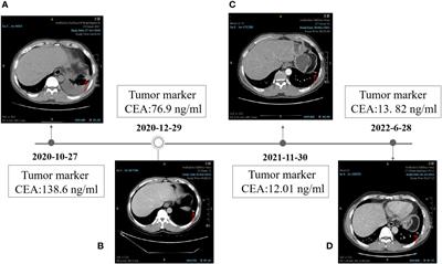 The novel EGFR mutations (p.E746_S752delinsI, p.T751_I759delinsG, p.L747_S752delinsAA) in patients with non-small cell lung cancer and the clinical treatment strategy: three case reports